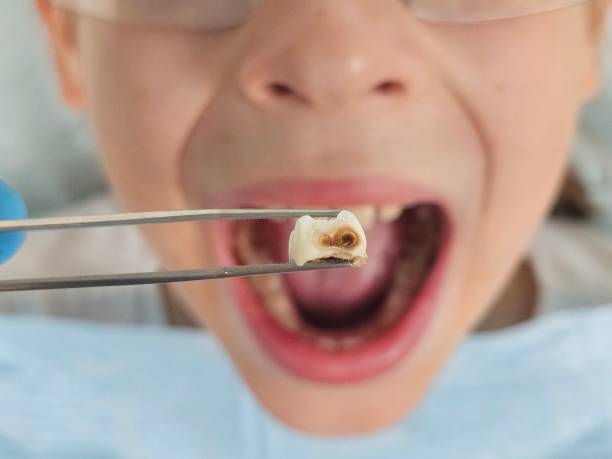 Best Broken or Cracked Tooth Emergency Dentist in Hinsdale, IL