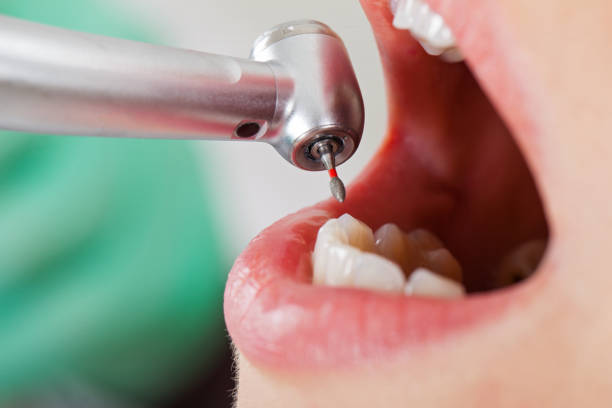Best Emergency Dentist for Lost Fillings or Crowns in Hinsdale, IL